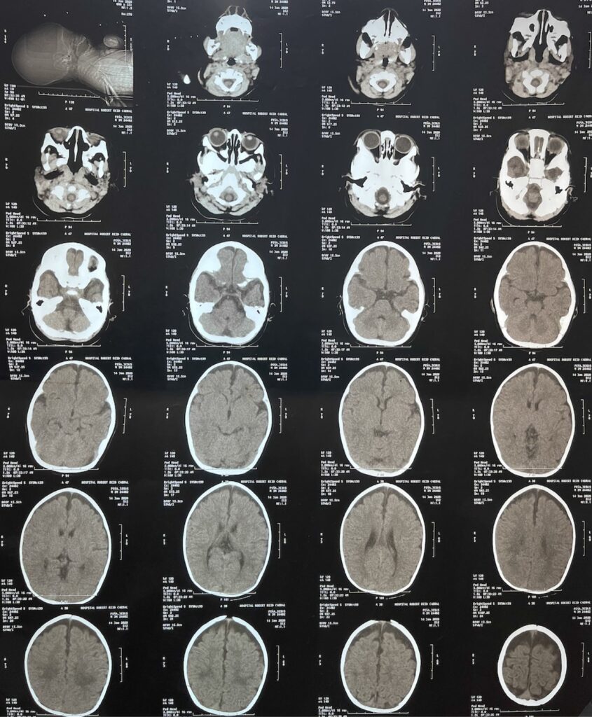 Allan-Herndon-Dudley syndrome 